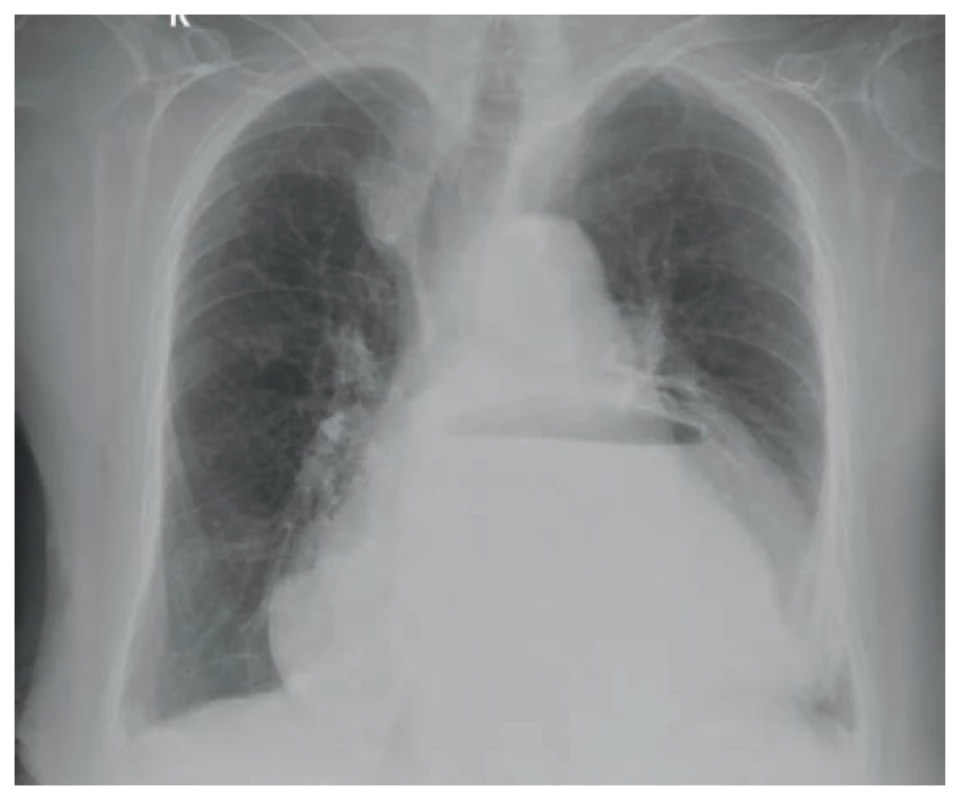 Volvulus žaludku na nativním zadopředním snímku hrudníku<br>
Fig. 1. Stomach volvulus on plain posterior-anterior chest X-ray
