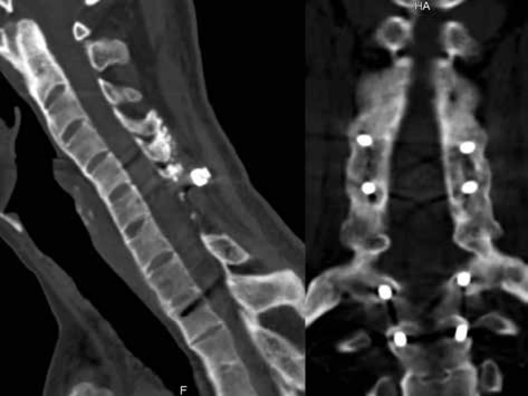 Průkaz solidní kostní fúze předního sloupce páteřního a laterálních mas prostřednictvím CT vyšetření 1 rok po fixaci zlomeniny C7 <br>
Fig. 3: The 1-year follow-up CT scan showing solid fusion of the ventral spinal column and both lateral masses after the C7 fracture