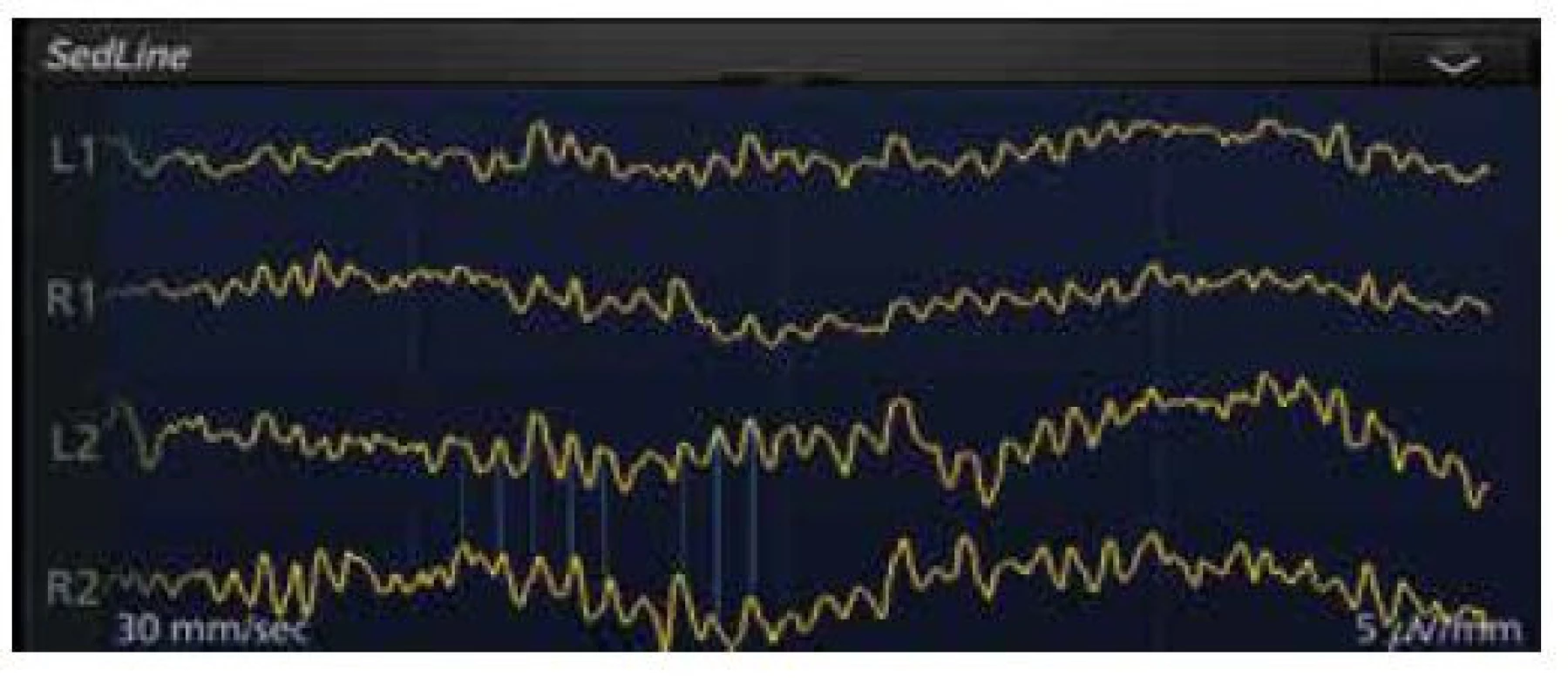 Na displeji monitoru SedLine je zdůrazněna koherence (korelace)
syrových EEG křivek snímaných z čela mezi L2 a R2 elektrodami u 69letého
pacienta s chronickou renální insuficiencí v celkové anestezii propofolem,
sevofluranem a sufentanilem k založení hemodialyzačního zkratu, Patient
State Index aktuálně 31 (doporučené rozmezí 25–50)
