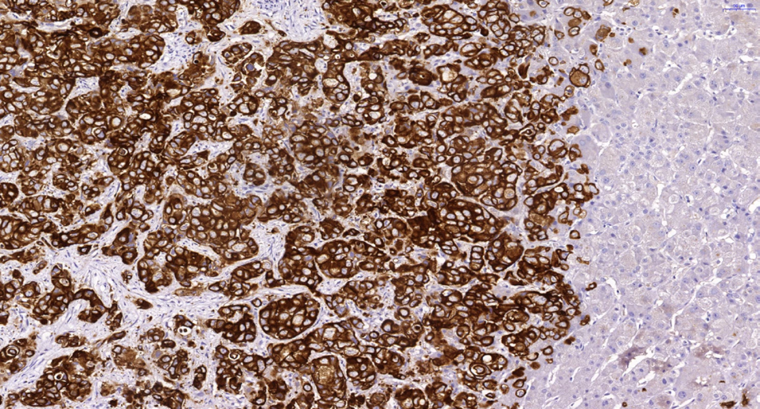Periferní typ intrahepatálního cholangiocelulárního karcinomu. Hnědě jsou zbarveny buňky CCC při imunohistochemickém průkazu cytokeratinu 7, vpravo jsou negativní jaterní buňky. Dále je patrná trabekulární stavba s anastomozováním nádorových trámců typická pro periferní intrahepatální CCC. Histologický řez z punkční biopsie, imunohistochemie CK7, 20×.

