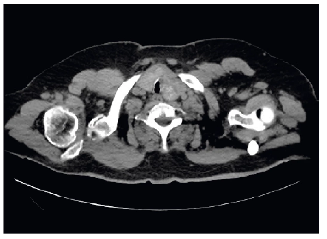 CT snímek před zavedením stentu (axiální) - výrazné
zúžení trachey v místě objemné strumy.