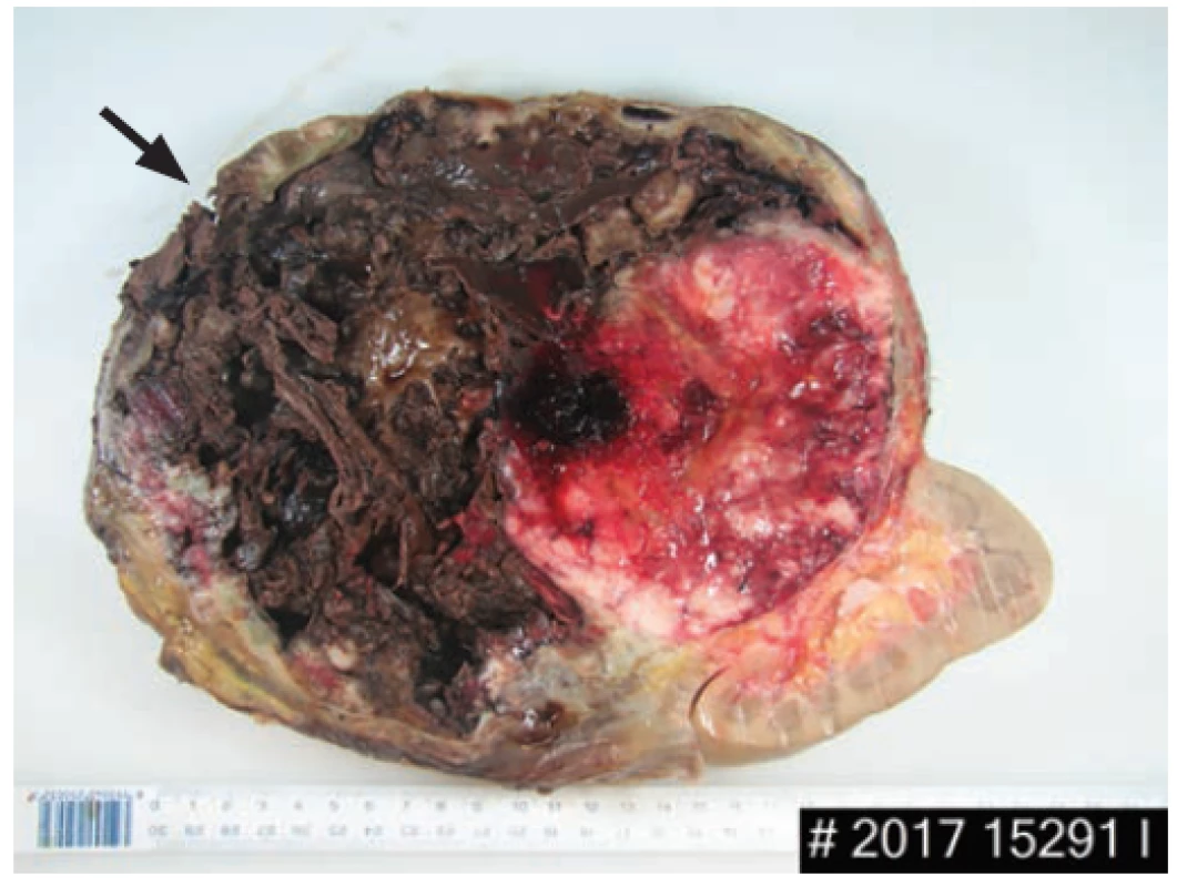 Cross section of a tumor and kidney with capsule
rupture pointed by an arrow