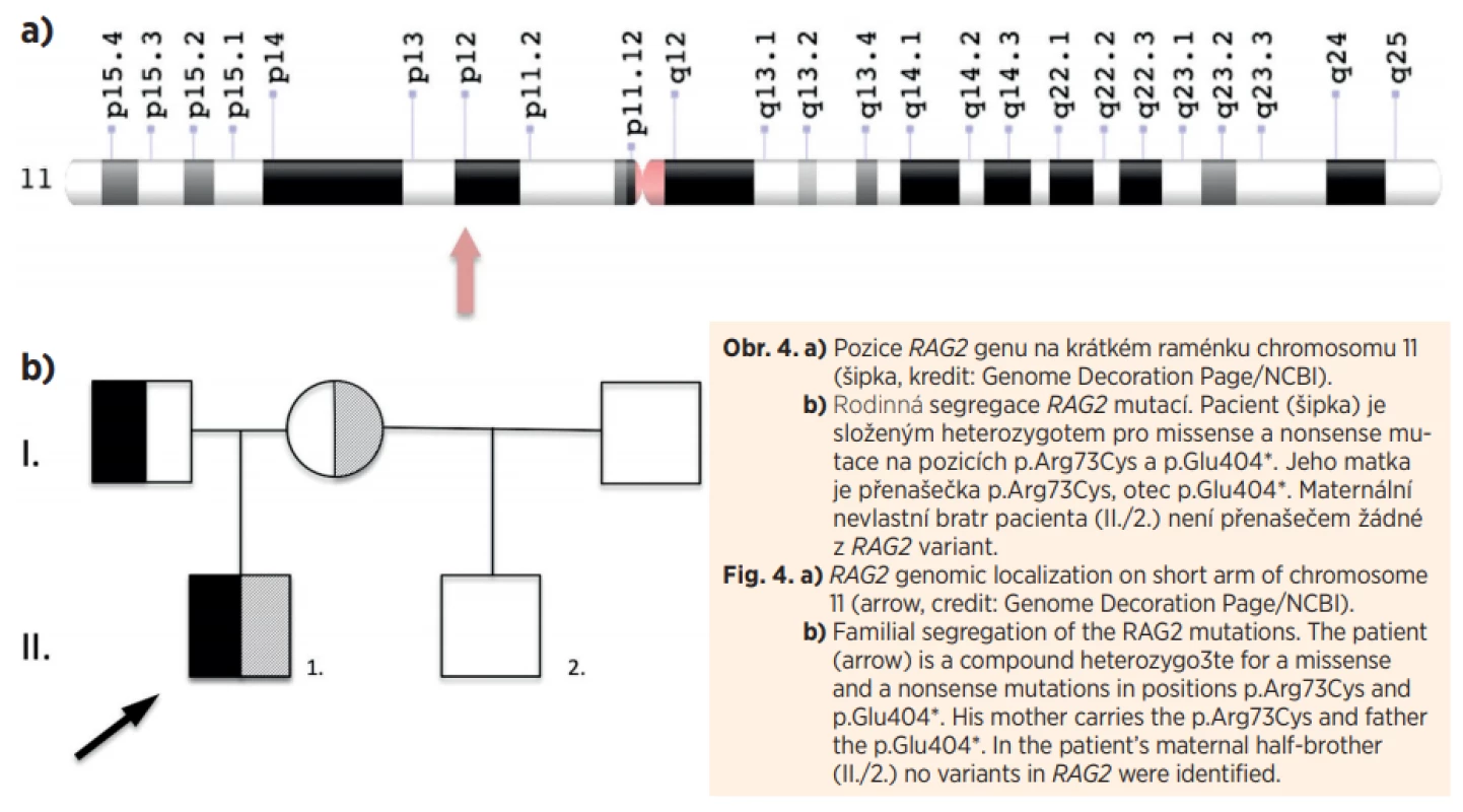 a) Pozice RAG2 genu na krátkém raménku chromosomu 11
(šipka, kredit: Genome Decoration Page/NCBI).
b) Rodinná segregace RAG2 mutací. Pacient (šipka) je
složeným heterozygotem pro missense a nonsense mutace na pozicích p.Arg73Cys a p.Glu404*. Jeho matka
je přenašečka p.Arg73Cys, otec p.Glu404*. Maternální
nevlastní bratr pacienta (II./2.) není přenašečem žádné
z RAG2 variant.<br>
Fig. 4. a) RAG2 genomic localization on short arm of chromosome
11 (arrow, credit: Genome Decoration Page/NCBI).
b) Familial segregation of the RAG2 mutations. The patient
(arrow) is a compound heterozygo3te for a missense
and a nonsense mutations in positions p.Arg73Cys and
p.Glu404*. His mother carries the p.Arg73Cys and father
the p.Glu404*. In the patient’s maternal half-brother
(II./2.) no variants in RAG2 were identified.