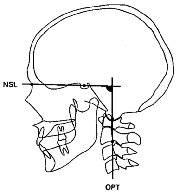 Úhel kraniocervikálního
zakřivení, který udává pozici
hlavy vzhledem k pozici
krčních obratlů; převzato
z Solow et al. [34]<br>
NSL: spojnice bodů N
(nasion) a S (sella turcica);
OPT: zakřivení krční páteře<br>
Fig. 2 Shows the position of the head
to the cervical column; the
craniocervical angle (NSL-OPT);
taken from [34]<br>
NSL: line from N (nasion) to
S (sella); OPT: inclination of the
cervical column