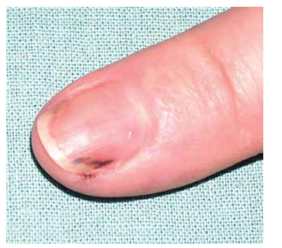 Třískovité hemoragie nehtů u pacientky s ANCA
asociovanou vaskulitidou