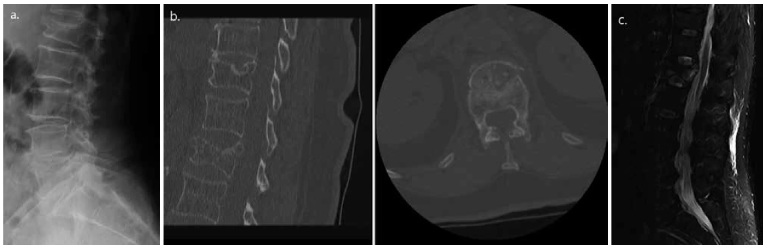 Osteoporotická komprese těla L1 charakteru kompletní tříštivé fraktury u 71leté pacientky (a. dle nativního RTG,
b. CT a c. MR)<br>
Fig. 1. Osteoporotic compression of vertebra L1, complete burst type in a 71 years old female patient (a. Native X-ray; b.
CT; and c. MRI scan)