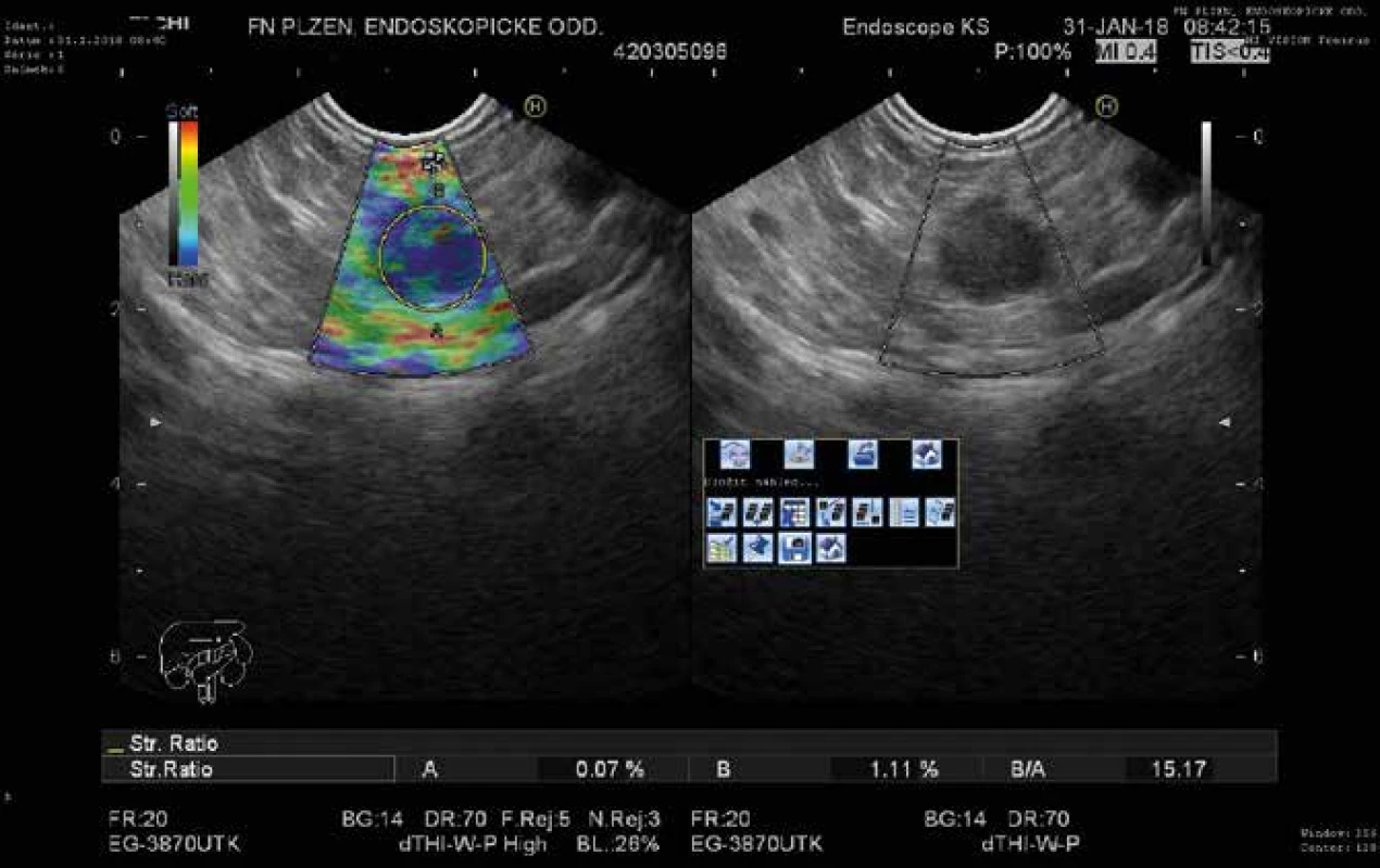Metastáza světlobuněčného karcinomu ledviny do pankreatu v endoUSG obraze<br>
Fig. 1: EUS findings of clear cell renal carcinoma metastasis to the pancreas 
