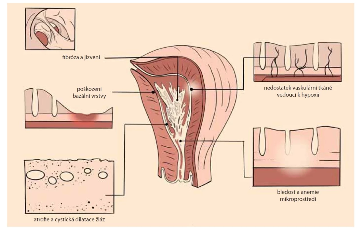 Patogeneze formace intrauterinní adheze [28].<br>
Fig. 1. Pathogenesis of intrauterine adhesion formation [28].