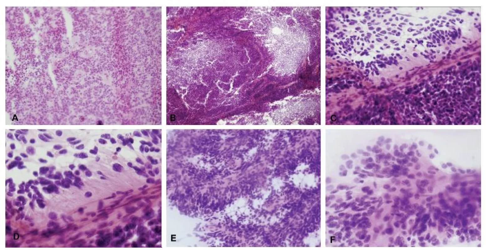 (A-D) Tumor IV. komory u 31-ročného muža. V zmrazenom reze bol zachytený výrazne celulárny tumor, ložiskovo s perivaskulárnymi pseudorozetami
(A). V nátere sa nádorové bunky „držia“ okolo ciev (B). Perivaskulárne pseudorozety – nádorové bunky sú k cievam prichytené gliálnymi výbežkami, jadrá sú
zoradené periférne (C, D). Pre vysokú celularitu a pomerne výrazné jadrové atypie bol nádor peroperačne nesprávne diagnostikovaný ako medulloblastóm.
Definitívna diagnóza: anaplastický ependymóm, grade III. (E, F) V inom prípade prítomnosť typických buniek s okrúhlymi jadrami a „salt and pepper“ chromatínom
umožnila správnu peroperačnú diagnózu ependymómu.