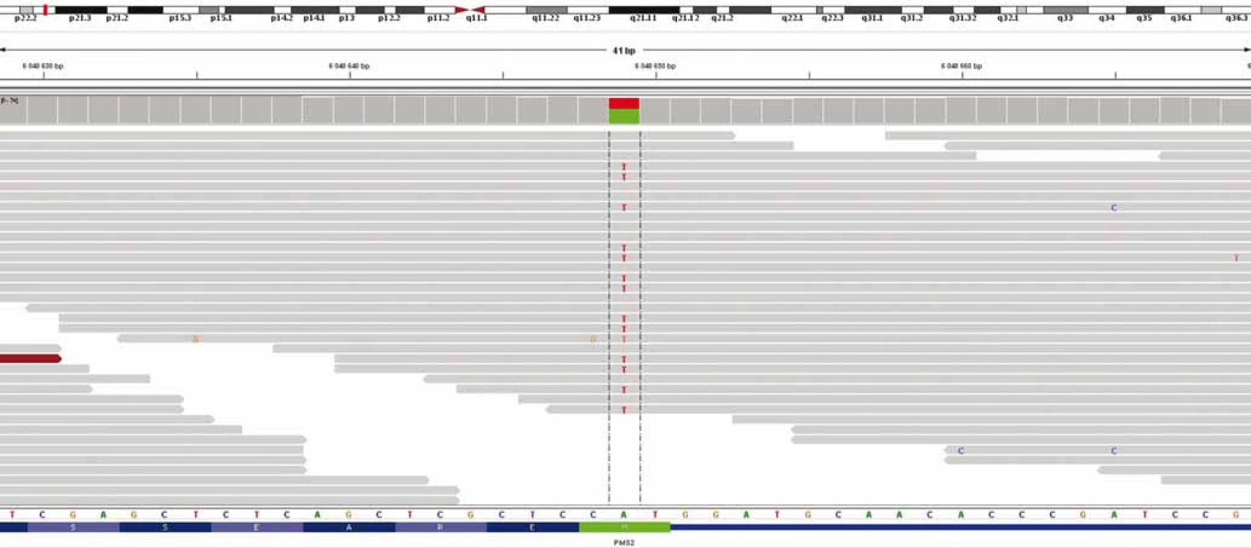 Výsledek celoexomového sekvenování – průkaz c.2T>A/p.M1K genu PMS2.