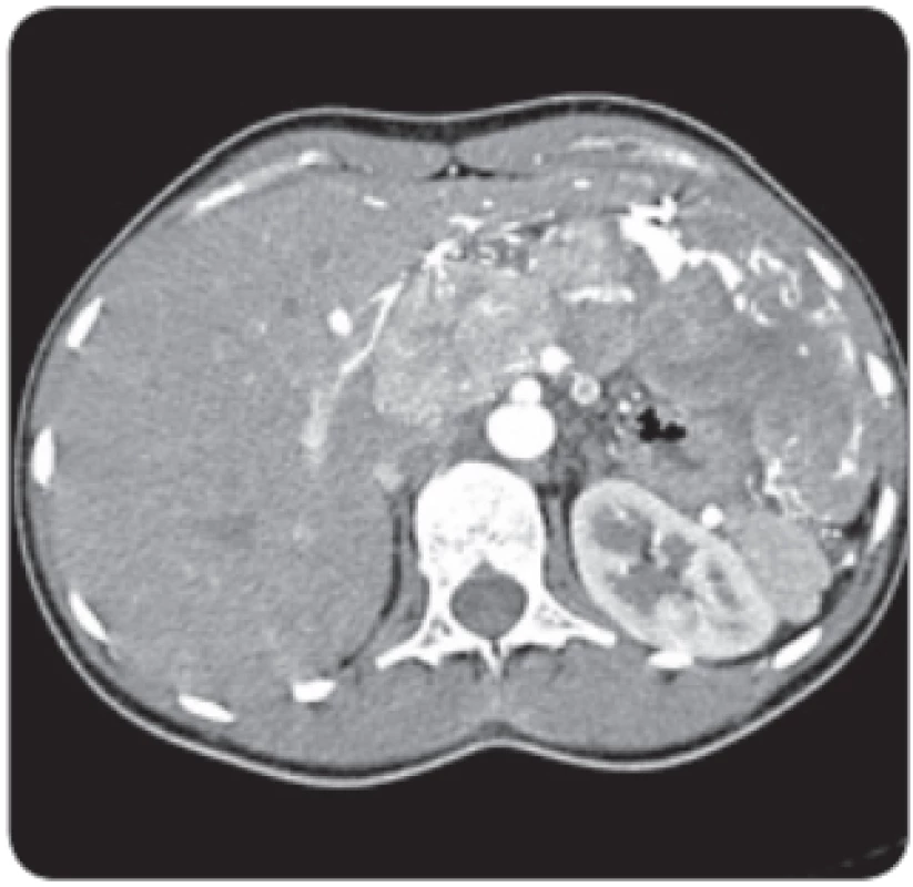  Vyšetření CT ukazuje typické chování hepatocelulárního karcinomu, hypervaskularizaci v arteriální fázi a vymývání ve fázi portální. Nález u mladé
24leté ženy charakteru typického fi brolamelárního karcinomu s postižením levého laloku a také s uzlinovými metastázami v portální skupině.
