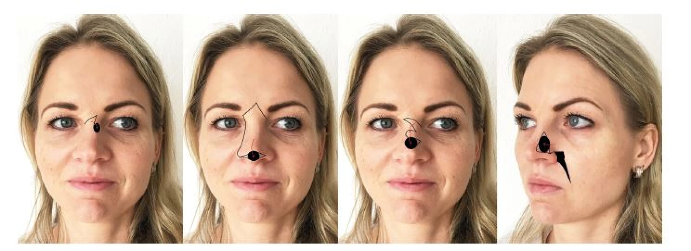 Možnosti uzávěru menších defektů kůže nosu: A) místní transpoziční praporový lalok, B) sesun kůže hřbetu nosu pro rekonstrukci
defektů špičky nosu, C) bilobed flap, D) posuvný tvářový lalok.