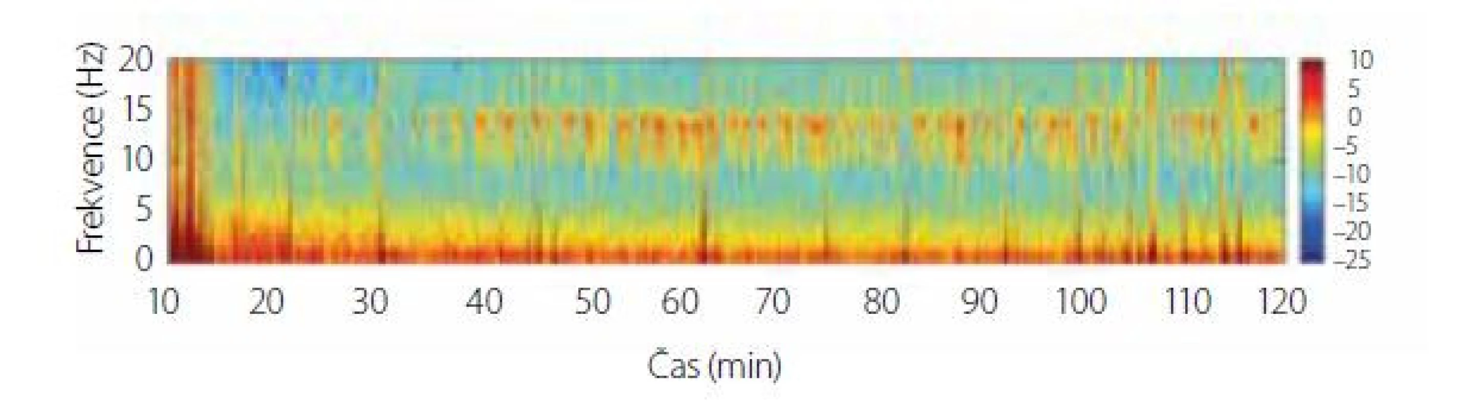 Spektrogram dexmedetomidinu v sedativní dávce. Na spektrogramu
jsou patrné pomalé oscilace v pásmu SW-δ a vřetena v pásmu α/β
(9-15 Hz). Upraveno z [10]