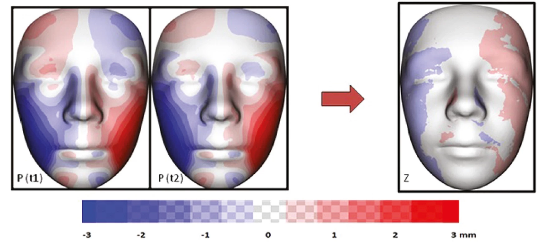 Vizualizace znázorňující
průměrnou individuální
asymetrii všech sledovaných
pacientů s OAVS v čase
t1 a t2 (P); barevná mapa
znázorňující změnu (v mm)
průměrné individuální
asymetrie mezi t1 a t2 (Z)<br>
Fig. 7
Visualization showing
the average individual
asymmetry of all OAVS patients
monitored at time t1 and t2
(P); a color map showing the
change (in mm) of the average
individual asymmetry between
t1 and t2 (Z)