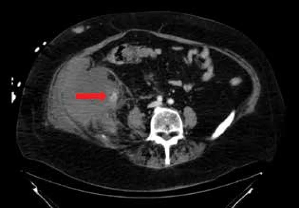 CT transverzální řez: hematom retroperitonea
vpravo s viditelným krvácením v mediokaudální porci
(označeno šipkou)<br>
Fig. 2: CT (transversal scan): hematoma of the retroperitoneum
on the right with visible bleeding in the mediocaudal
part (indicated by an arrow)