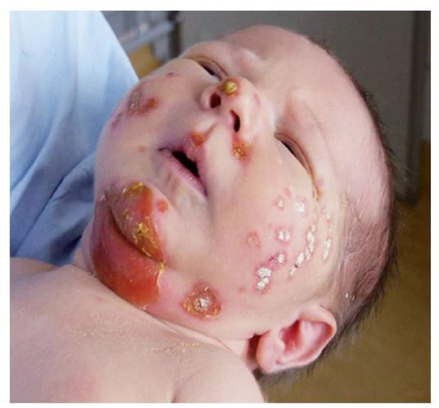 Dvoutýdenní novorozenec s bulózním impetigem – na bradě
eroze po stržení krytby puchýře