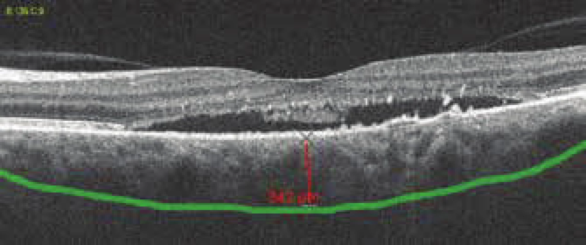 Pachychoroid, thickness of choroidea 342 μm