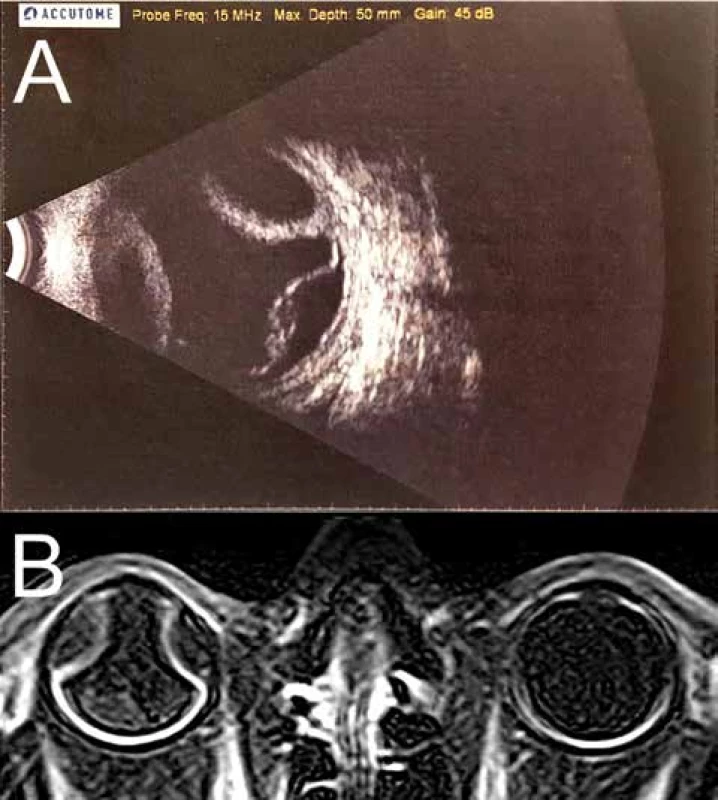 (A) Ultrazvuková sonografie bulbu pravého oka, B scan, listopad 2017. Shora ablace
choroidey, zdola serózní odchlípení sítnice. (B) magnetická rezonance orbit, T1 vážený
obraz, listopad 2017. Ablace choroidey a serózní odchlípení sítnice