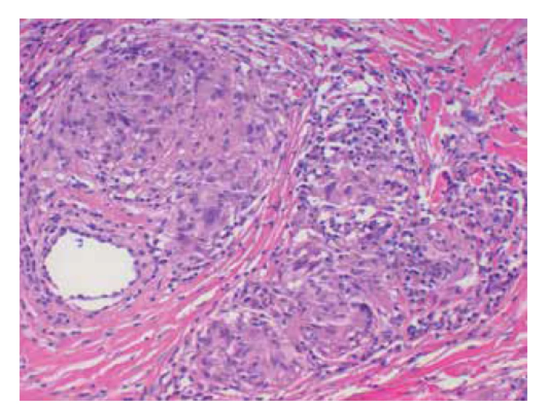 Sarkoidální granulomy u necrobiosis lipoidica
(HE 200x)