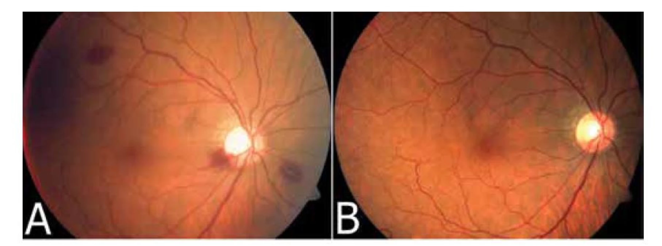 Fotodokumentace sítnice pravého oka bezprostředně po explantaci arteficiální duhovky
ukazující intraretinální hemoragie peripapilárně a v periferii sítnice (A) a následné vstřebání
hemoragií (B)
