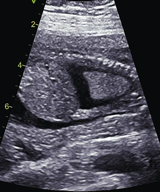 Fetální pleurální výpotek.<br>
Fig. 3. Fetal pleural effusion.