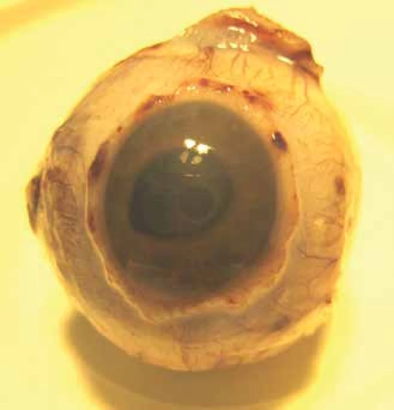 Enukleovaná očná guľa v r. 2013