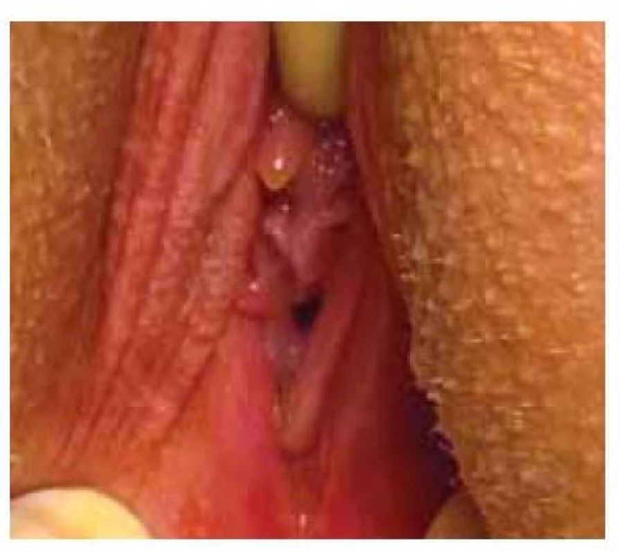 Vzhled vaginálního introitu
u pacientky s transverzálním vaginálním
septem – za hymenem prostupná
distální část pochvy.<br>
Fig. 4. Appearance of the vaginal introitus
in a patient with a transverse vaginal
septum – the distal part of the vagina
permeable behind the hymen.