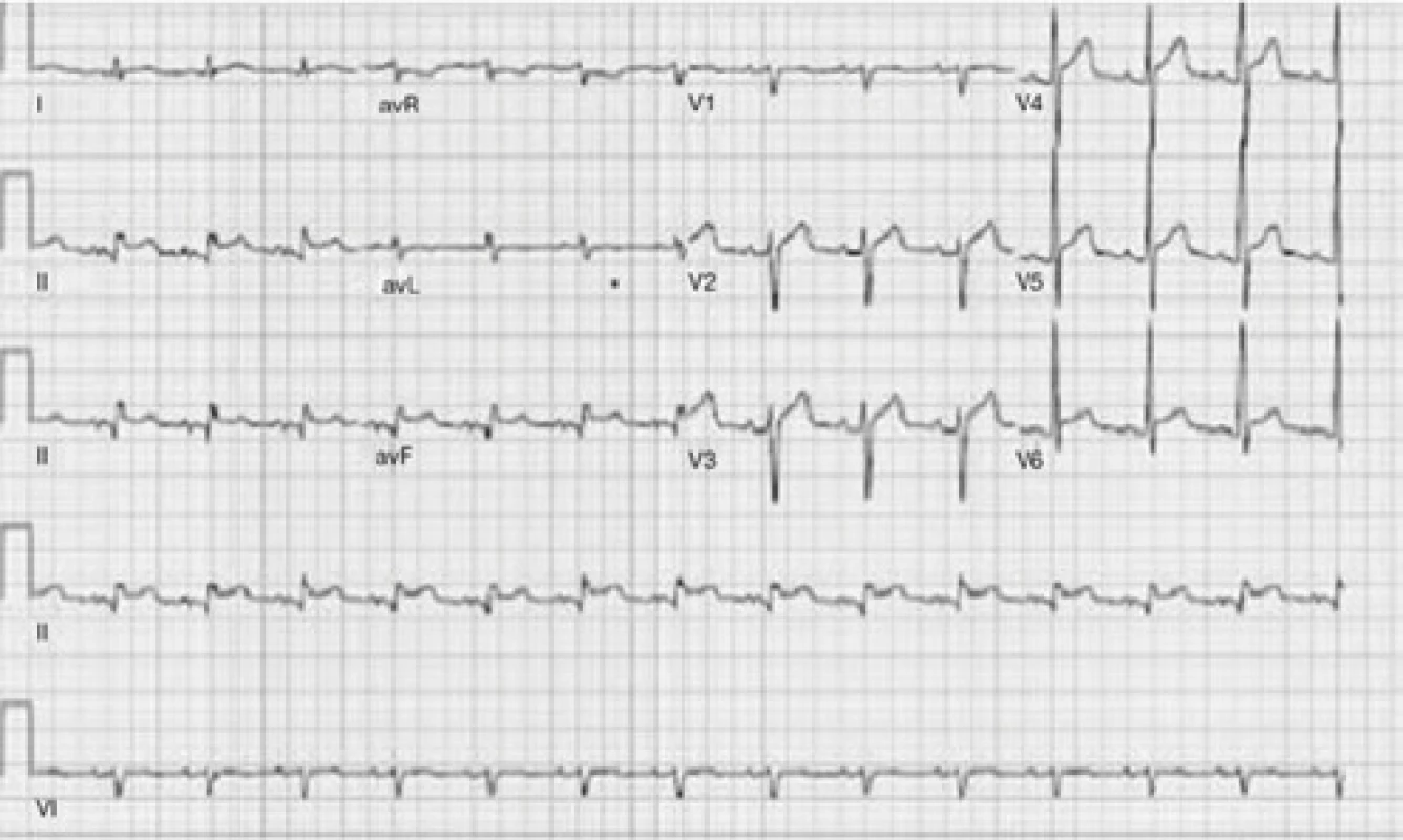 Elevácie ST v II, III, aVF, V5-V6 bez kontralaterálnych depresií ST na 
EKG hodnotené ako inferolaterálny STEMI 