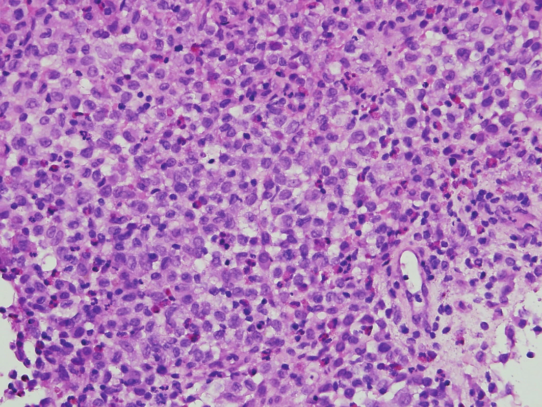 Histiocytóza z Langerhansových bb. (hematoxylin-eosin,
zvětšení 400x)<br>
Langerhansovy buňky mají světlou cytoplazmu a bledá ledvinovitá
jádra se zářezy. Příměs tvoří zejména eozinofily.