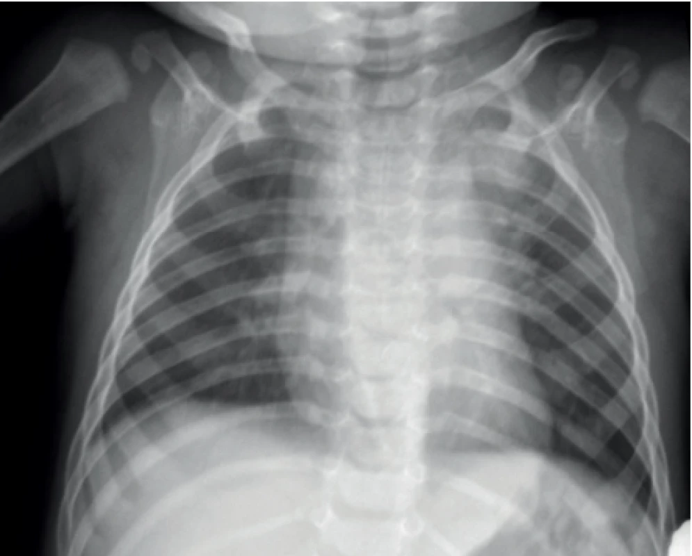 SKG hrudníku u 9měsíčního chlapce s TB plic vlevo,
forma infiltrativní, mikroskopicky negativní, kultivačně
pozitivní.<br>
Fig. 3. Chest X-ray of 9 months old boy with pulmonary TB.