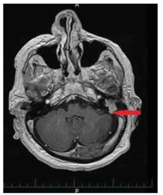 MR mozku, axiální projekce:
tumor středouší vlevo s propagací do
intrakrania v rozsahu 2 mm (šipka).><br>
Fig. 5. MRI of brain, axial projection:
tumour of middle ear, left side with
intracranial propagation in the range
of 2 mm (arrow).