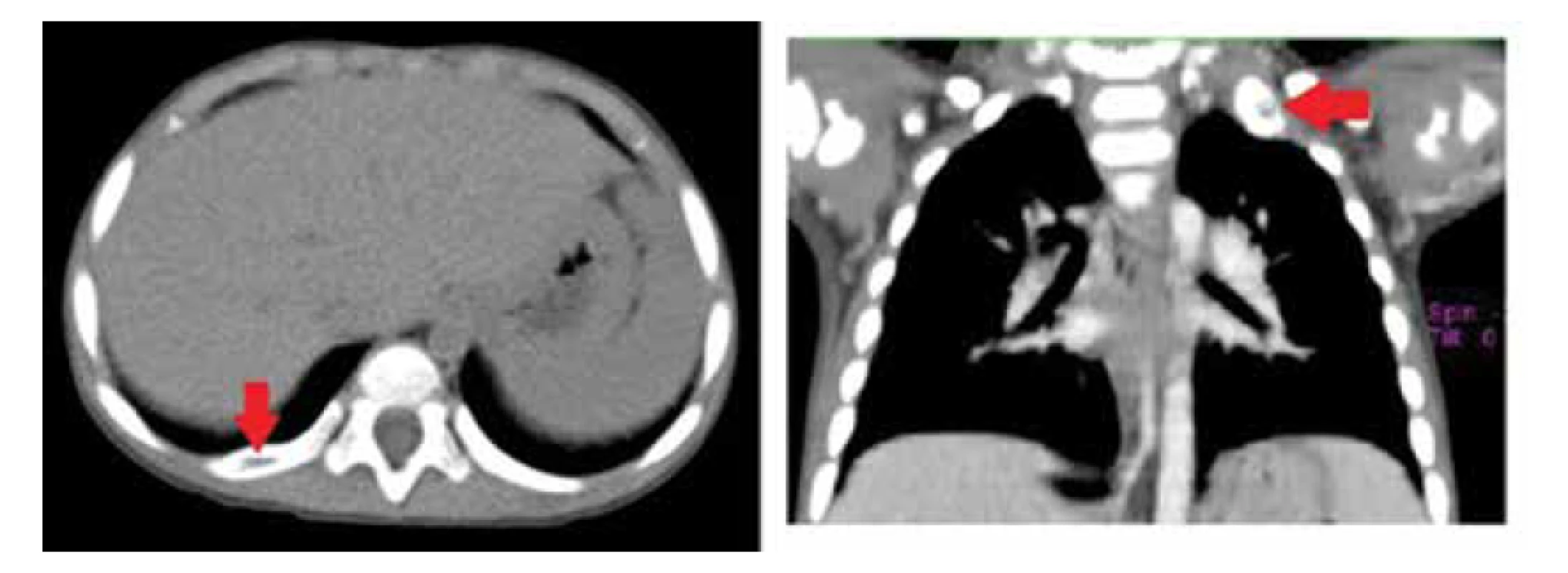 CT nález osteolytických ložísk v rebrách (zdroj: archív autorov).<br>
Fig. 5. Osteolytic lesions in the ribs on CT scan (source: authors’ archive).