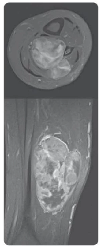 Magnetická rezonance sarkomu
v laterální části bérce nad zevním kotníkem
– vyšetření před hypertermickou izolovanou
perfuzí končetiny (leden 2018).