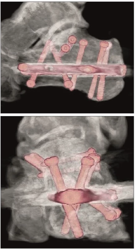 Pooperační VRT obrazy po osteosyntéze zlomeniny patní kosti
hřebem C-nail