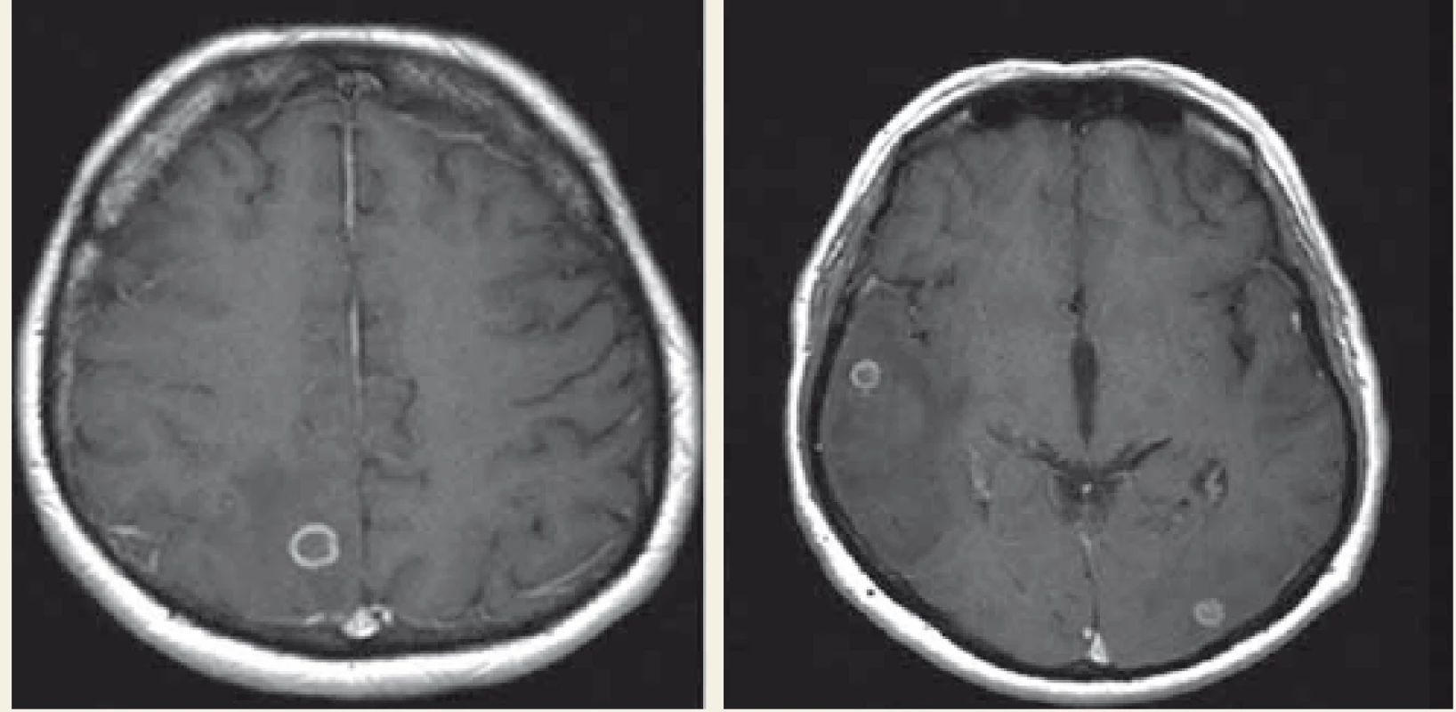 MR mozku, první vyšetření – prstenčitá ložiska, s maximem 11 × 12 mm
parietálně vpravo, perifokální edém temporoparietálně vpravo a okcipitálně
vlevo.<br>
Fig. 2. MRI of brain, the first examination – ring shaped focus, with a maximum right
parietal 11 × 12 mm, perifocal oedema temporoparietal left and right occipital.