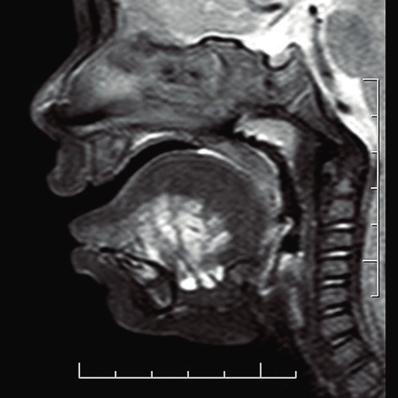 Mikrocystická lymfatická malformácia jazyka - MRI vyšetrenie
(T2 váženie).