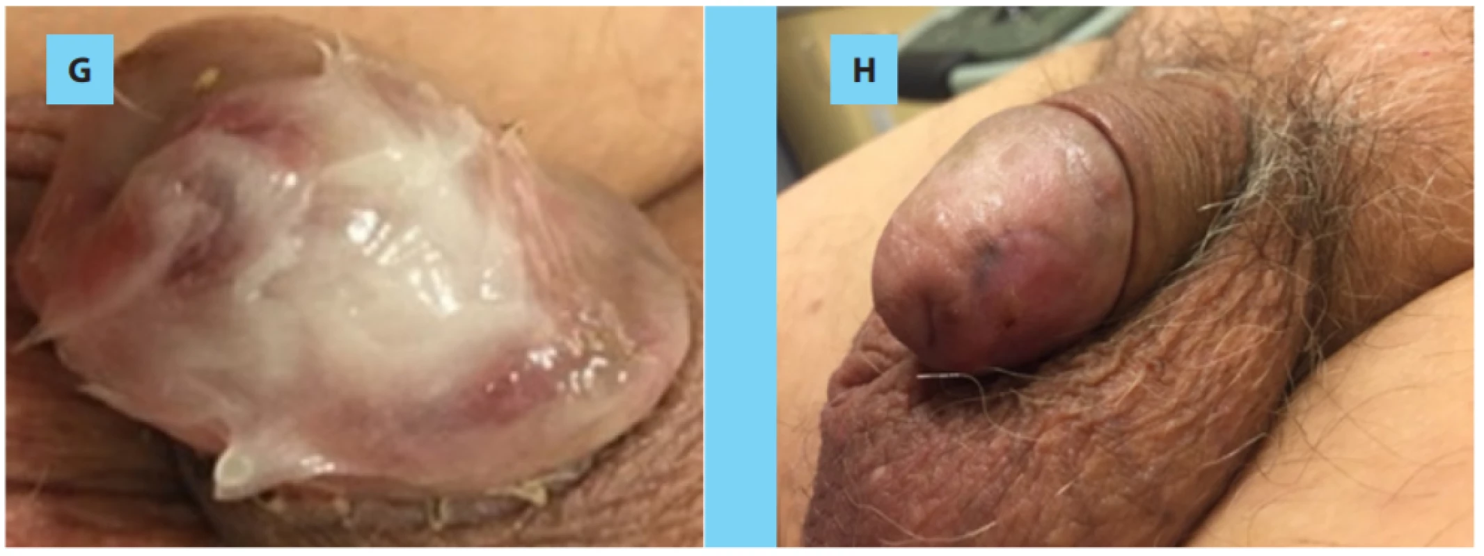 . A) 9 weeks after the primary excision; B) demarcation of the glans area; C) re-excision of the glans;
D) coverage with the Veriset, which was fixed with a few 4.0 resorbable sutures; E) 3rd postoperative day, F) 7
days after the procedure; G) local wound care with vaseline mixed with baneocin cream; H) final appearance
of the glans (week number 8).<br>
Obr. 2. A) Devět týdnů po primární excizi; B) vymezení oblasti glandu; C) reexcize glandu; D) překrytí náplastí
Veriset, která byla připevněna několika vstřebatelnými stehy 4/0; E) třetí pooperační den; F) sedm dnů po zákroku;
G) lokální péče o ránu za použití vazelíny smíchané s mastí baneocin; H) konečný vzhled glandu (8. týden)