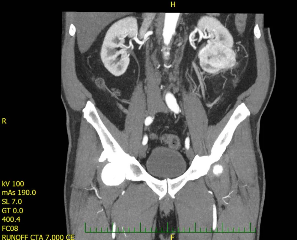 CT zobrazující nádor levé ledviny<br>
Fig. 1. CT scan showing tumor of left kidney