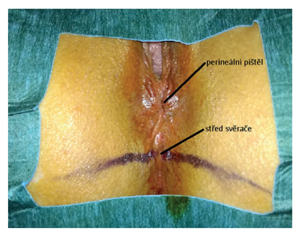 Předoperační stav perineální oblasti s perineální píštělí<br>
Fig. 2: Preoperative condition of the perineal area with the
perineal fistula