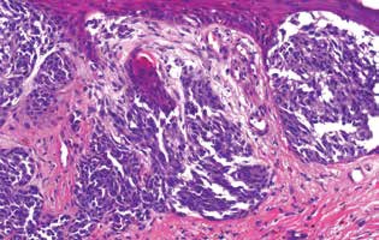 Růžová část – vertikální růstová fáze melanomu (HE,
200x)