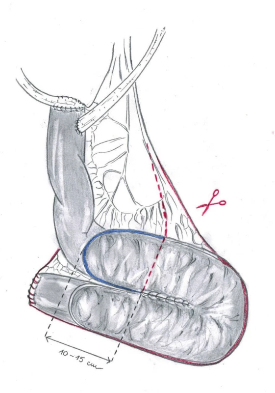 Červená linie ohraničuje část neoveziky, která
se odstraní při operaci<br>
Fig. 3. The red line delineates the part of neobladder to
be removed during the surgery