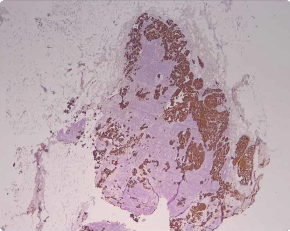 Lymfatická uzlina z oblasti krčku žlučníku se zachycenými kohezivními, mikropapilárně až papilárně formovanými nádorovými elementy. Imunohistochemické barvení CK7. Zvětšení 20×. (Archiv autorů).