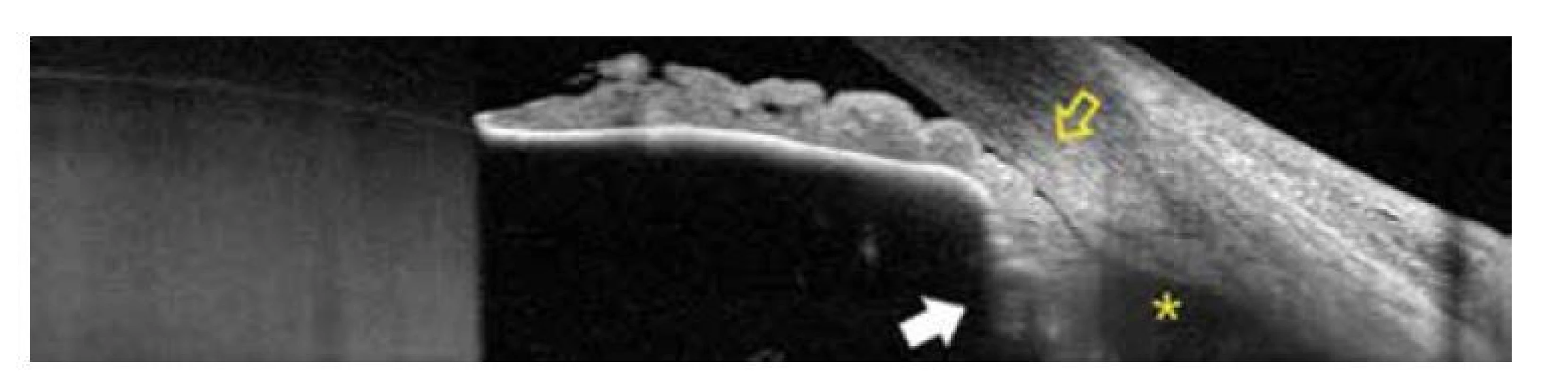 OCT snímek předního segmentu levého oka po prvotní terapii, uzávěr úhlu (žlutá
šipka), rotace ciliárního tělesa dopředu (bílá šipka), supraciliární efuze (hvězdička)
