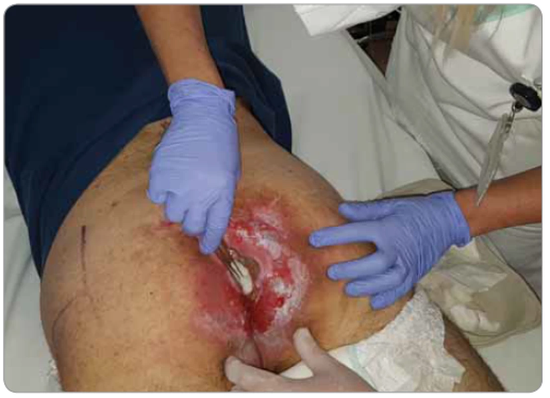 Ošetřování pacienta s akutní radiodermatitidou s erytémem a exfoliací krátce
po radioterapii exulcerovaného karcinomu kůže v sakrokokcigeální oblasti (foto S. Vokurka,
FN Plzeň).