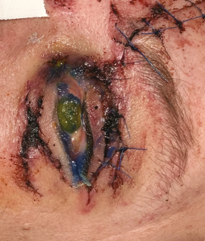Fotografie ukazuje vzácnější komplikaci okuloplastických traumat – pacient po úraze (autonehoda) – pravděpododobně ztrátové poranění horního víčka po primární
rekonstrukci – s  nálezem expoziční keratitis při lagoftalmu na
podkladě nedovírání oční štěrbiny 