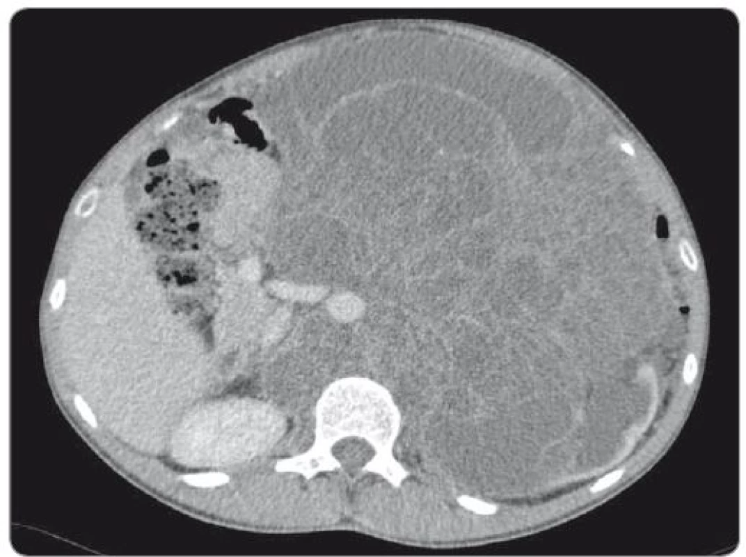 Abdominal CT scan showing huge retroperitoneal mass encircling aorta and inferior
caval vein.