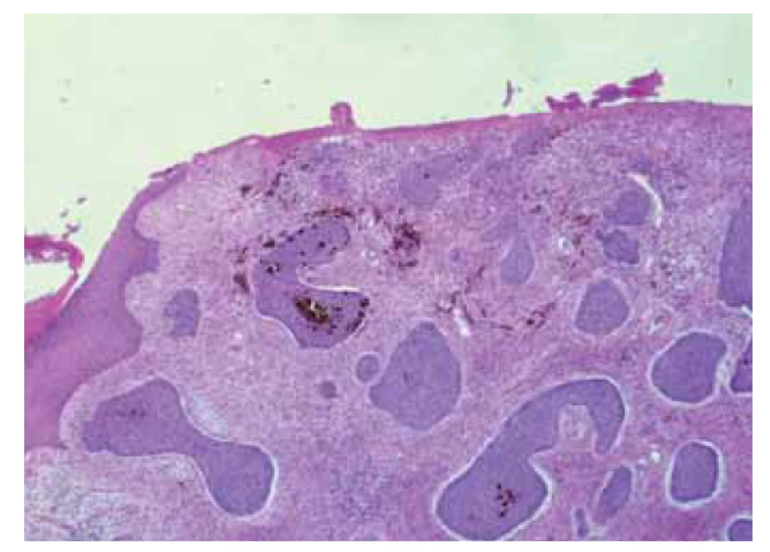 Pigmentovaný bazocelulární karcinom.<br>
Fig. 8. Pigmented basal cell carcinoma.