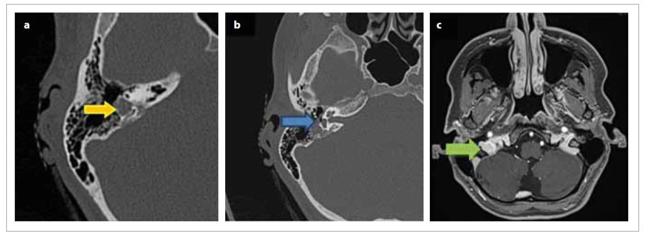 HRCT zobrazenie tumoru: a) tumor labyrintu vnútorného ucha (žltá šípka označuje tumor),
b) uzurácia vestibula a zavzatie n. VII (modrá šípka), c) MR obraz tumoru (zelená šípka).<br>
Fig. 2. HRCT tumor imaging: a) inner ear labyrinth tumor (yellow arrow indicates tumor), b) vestibular occlusion and n. VII uptake
(blue arrow), c) MR image of tumor (green arrow).