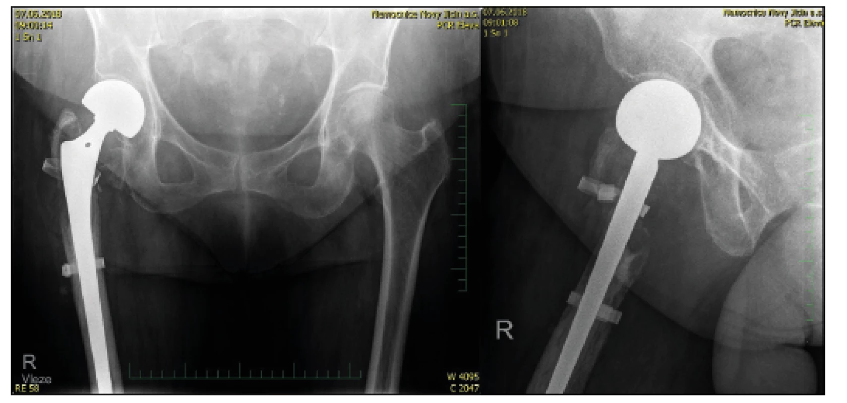 76-year-old female with comminuted fracture of the trochanteric
massive, control X-ray after implantation of total joint endoprosthesis
with stabilizing cerclage