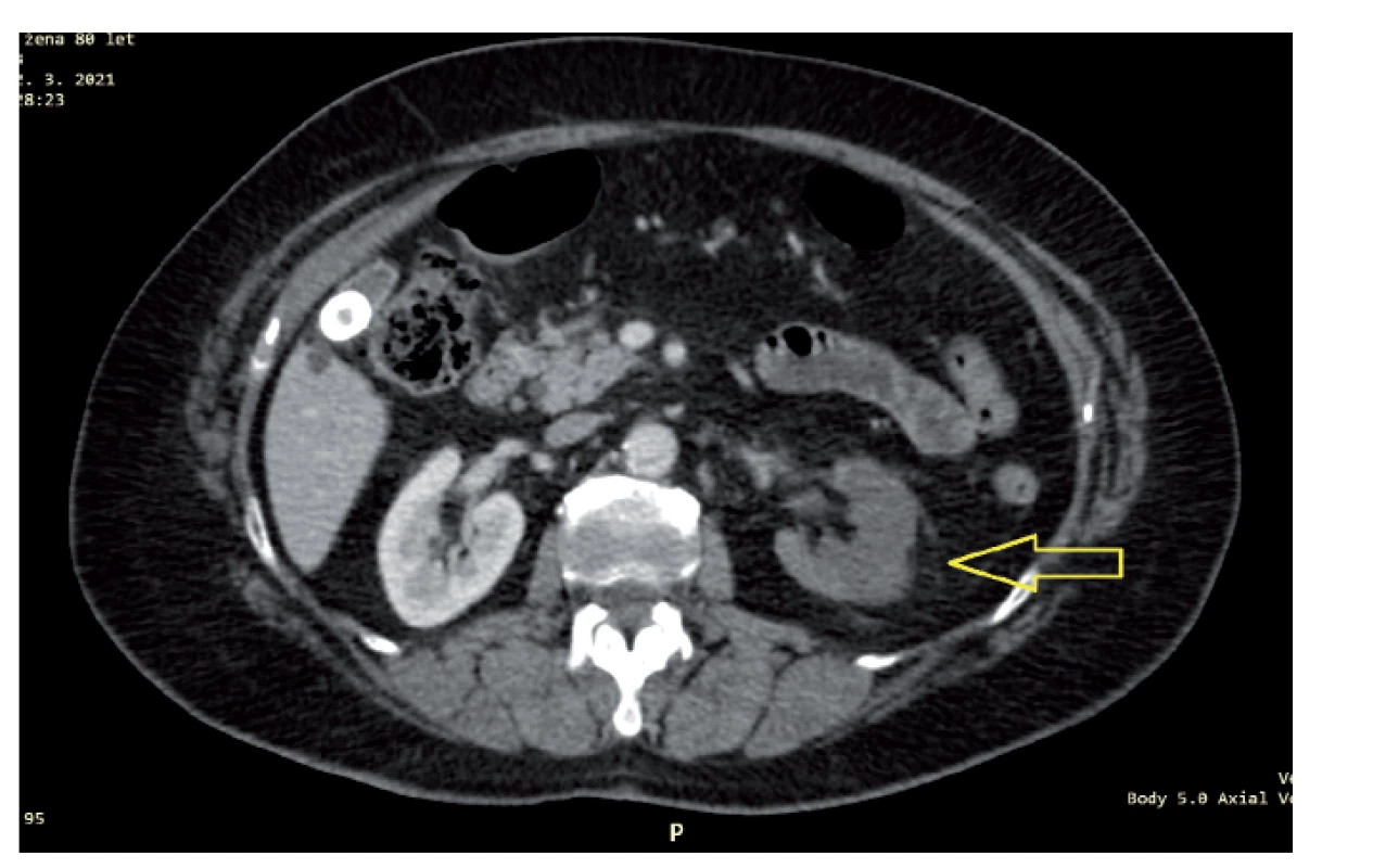 Nápadně nízké postkontrastní sycení levé ledviny (vyznačena šipkou)